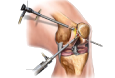Knee Arthroscopy