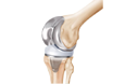 Knee Replacement