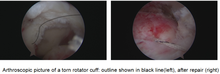 Arthroscopy picture of a torn rotator cuff