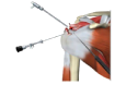 Shoulder Arthroscopy